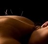 Акупунктура (рефлексотерапия, иглоукалывание), отдых все включено №4
