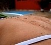 Акупунктура (рефлексотерапия, иглоукалывание), отдых все включено №12